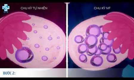 Quy trình IVF